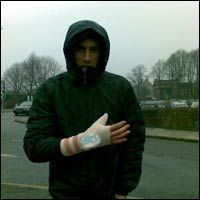 Gee Atherton damages his thumb!