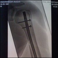 Roger Rinderknecht fractured his arm during a training session - Second Image