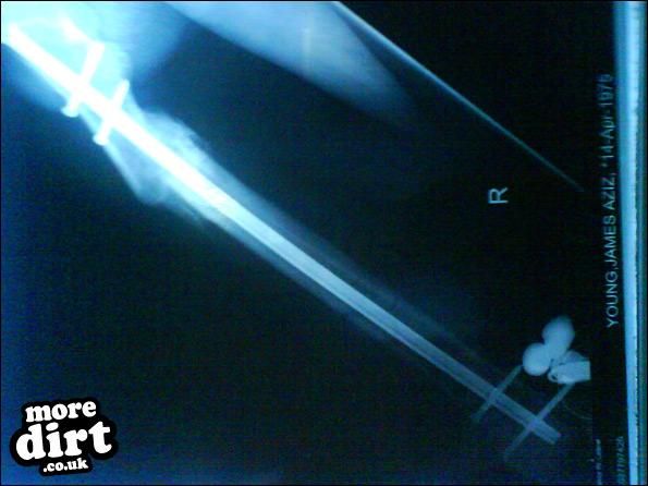 THIS IS MY RIGHT LEG...STILL RIDE HARD THOUGH!!!!