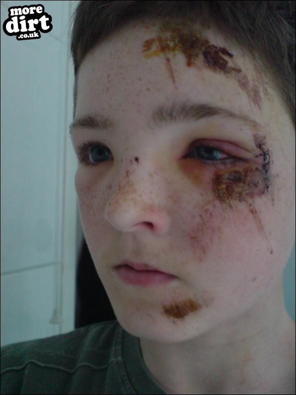 serious case of road rash but seriously 7 stitches