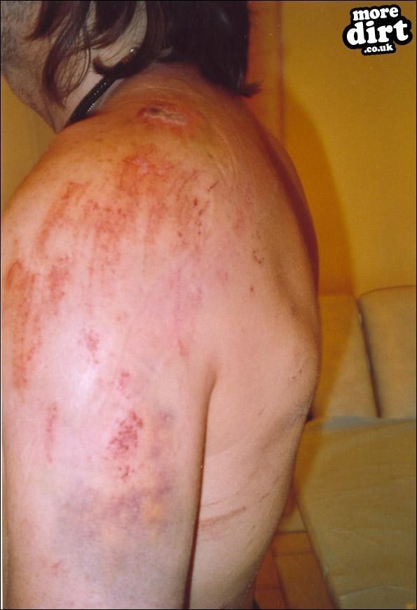 big jump... broke colour bone, separated shoulder,