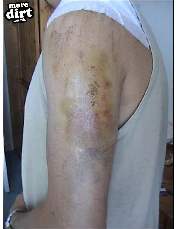 big jump... broke colour bone, separated shoulder,