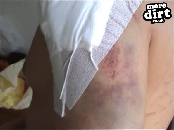 big jump... broke colour bone, separated shoulder,