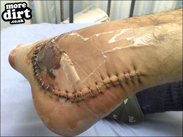 All That From A Bad Landin'!!!