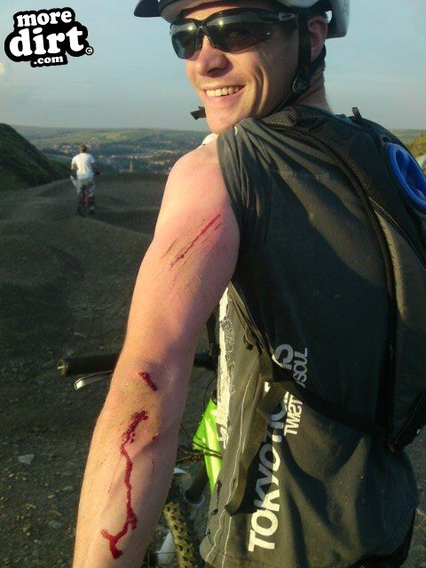 Came off on the pump track and it stings like hell