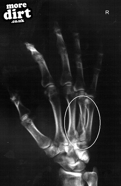 Thats the bone I broke at the weekend